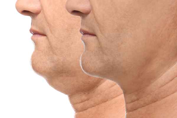 HIFU - Breakthrough in Anti - ageing 2 hifu results Nantwich