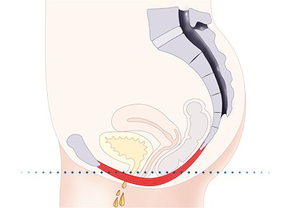 Pelvic-Floor Muscle Repair 5 Pelvic floor muscles Nantwich