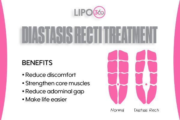 Revolutionising Muscle Repair: The Power of LIPO360 Body Sculpt Post-Injury 5 diastasis recti treatment Nantwich