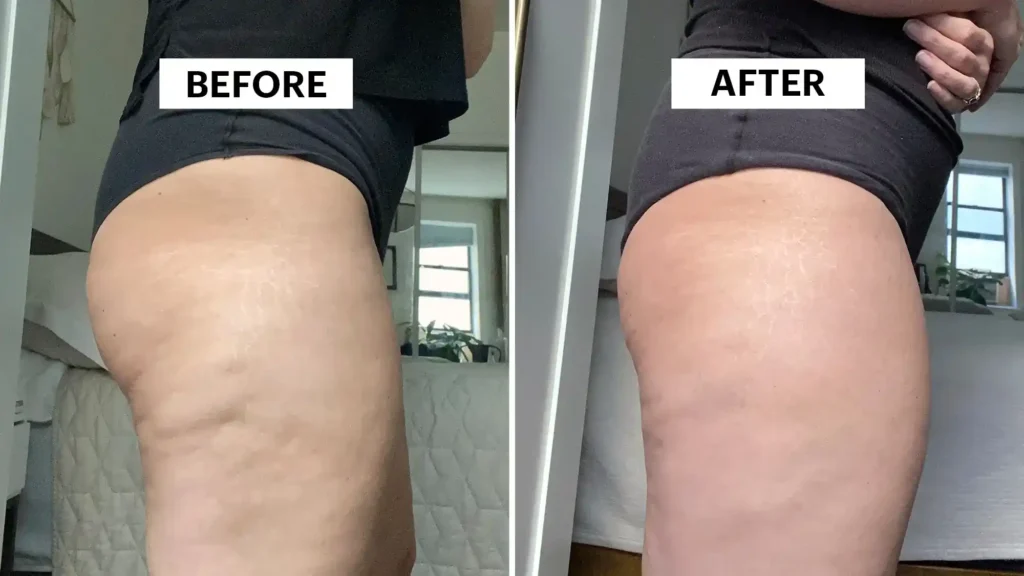 Sculpting Your Bum: Can Toning Exercises Really Reduce Cellulite? 1 Do Toning Exercise Nantwich Really Tackle Cellulite?