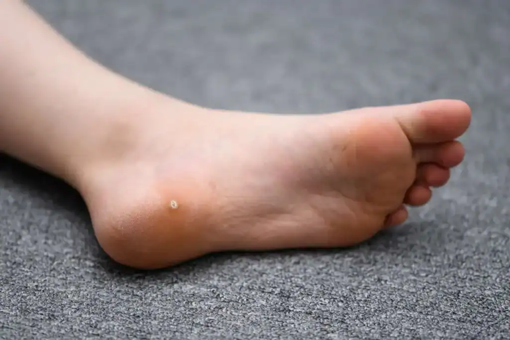 Cryotherapy For Warts And Also Verrucas 2 Image of verruca on the bottom of the foot that able to be treated with Cryotherapy Nantwich