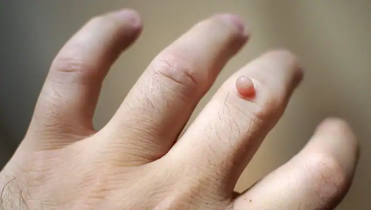 Cryotherapy For Warts And Also Verrucas 1 Image of blemish that Cryotherapy Nantwich can remove with Lipo 360.