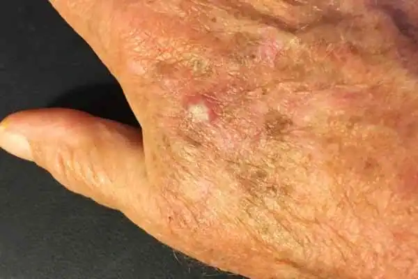 Cryopen For Actinic Keratoses 1 Image of Actinic keratoses Nantwich on a person hand
