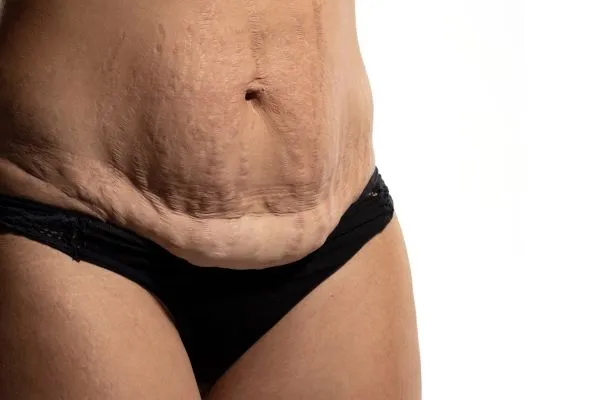 The Science of Skin Tightening 1 The science behind skin tightening Nantwich picture of a woman's sagging skin on the stomach